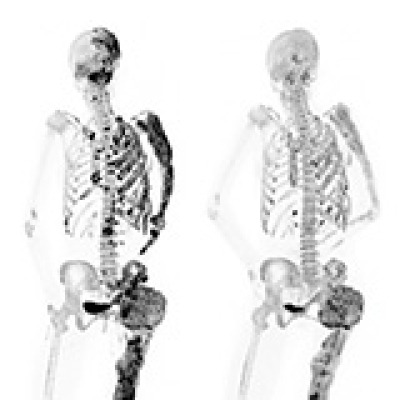 Bone scans of a patient before (left) and after (right) a six-month denosumab treatment show reduced turnover within fibrous dysplasia lesions (dark-colored patches). 